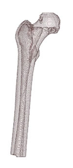 A screw anchored intramedullary hip stem
